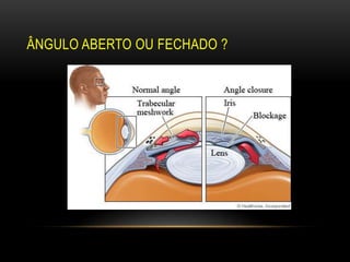 ÂNGULO ABERTO OU FECHADO ?
 