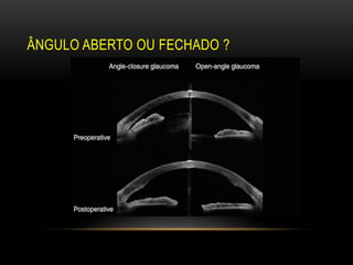 ÂNGULO ABERTO OU FECHADO ?
 
