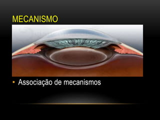 MECANISMO
• Bloqueio pupilar
• Íris em Platô (Plateau)
• Fechamento angular induzido pelo
cristalino
• Associação de mecanismos
 