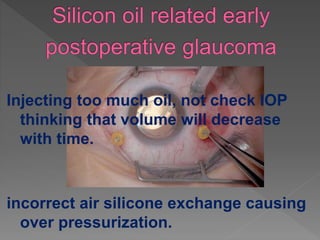Injecting too much oil, not check IOP
thinking that volume will decrease
with time.
incorrect air silicone exchange causing
over pressurization.
 