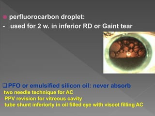  perfluorocarbon droplet:
- used for 2 w. in inferior RD or Gaint tear
PFO or emulsified silicon oil: never absorb
- two needle technique for AC
- PPV revision for vitreous cavity
- tube shunt inferiorly in oil filled eye with viscot filling AC
 