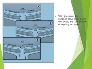 With glaucoma, the
ganglion nerve layer slowly
dies away, and the amount
of cupping increases.
 