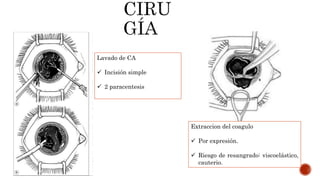 Lavado de CA
 Incisión simple
 2 paracentesis
Extraccion del coagulo
 Por expresión.
 Riesgo de resangrado: viscoelástico,
cauterio.
 