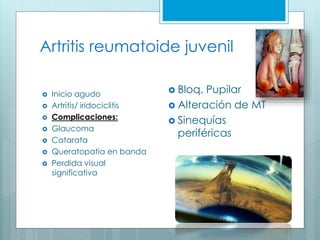 Artritis reumatoide juvenil
 Inicio agudo
 Artritis/ iridociclitis
 Complicaciones:
 Glaucoma
 Catarata
 Queratopatia en banda
 Perdida visual
significativa
 Bloq. Pupilar
 Alteración de MT
 Sinequías
periféricas
 