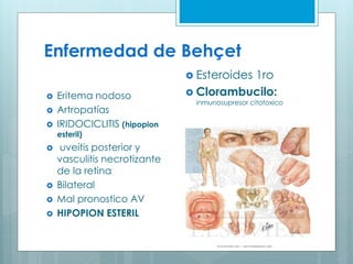 Enfermedad de Behçet
 Eritema nodoso
 Artropatías
 IRIDOCICLITIS (hipopion
esteril)
 uveítis posterior y
vasculitis necrotizante
de la retina
 Bilateral
 Mal pronostico AV
 HIPOPION ESTERIL
 Esteroides 1ro
 Clorambucilo:
inmunosupresor citotoxico
 