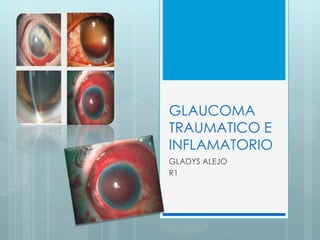 GLAUCOMA
TRAUMATICO E
INFLAMATORIO
GLADYS ALEJO
R1
 