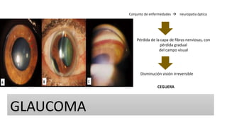 GLAUCOMA
Conjunto de enfermedades  neuropatía óptica
Pérdida de la capa de fibras nerviosas, con
pérdida gradual
del campo visual
Disminución visión irreversible
CEGUERA
 