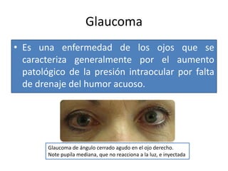 Glaucoma
• Es una enfermedad de los ojos que se
caracteriza generalmente por el aumento
patológico de la presión intraocular por falta
de drenaje del humor acuoso.

Glaucoma de ángulo cerrado agudo en el ojo derecho.
Note pupila mediana, que no reacciona a la luz, e inyectada

 