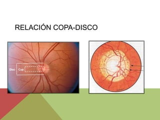 RELACIÓN COPA-DISCO
 