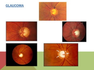 GLAUCOMA
 