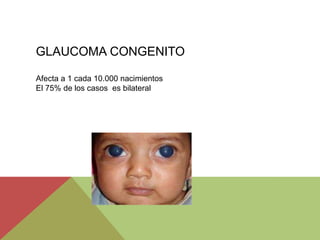 GLAUCOMA CONGENITO
Afecta a 1 cada 10.000 nacimientos
El 75% de los casos es bilateral
 
