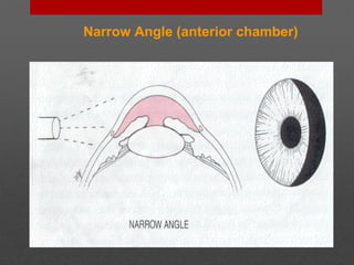 Narrow Angle (anterior chamber)
 