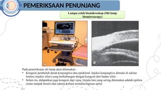 PEMERIKSAAN PENUNJANG
Lampu celah biomikroskop (Slit lamp
biomicroscopy)
Pada pemeriksaan slit lamp akan ditemukan :
• Kongesti pembuluh darah konjungtiva dan episkleral. Injeksi konjungtiva dimulai di sekitar
limbus (injeksi silier) yang berhubungan dengan kongesti dari badan silier .
• Selain itu, didapatkan juga kongesti dari vena. Gejala lain yang sering ditemukan adalah epifora
(mata tampak berair) dan edema kornea terutama lapisan epitel
 