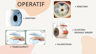 OPERATIF
IRIDOTOMY
IRIDECTOMY
TRABECULOPASTY
GLAUCOMA-
DRAINAGE SURGERY
SIKLODESTRUKSI
 