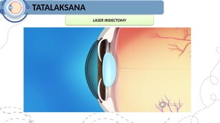 TATALAKSANA
LASER IRIDECTOMY
 