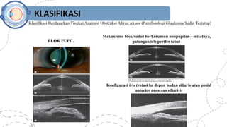 KLASIFIKASI
Klasifikasi Berdasarkan Tingkat Anatomi Obstruksi Aliran Akuos (Patofisiologi Glaukoma Sudut Tertutup)
BLOK PUPIL
Mekanisme blok/sudut berkerumun nonpupiler—misalnya,
gulungan iris perifer tebal
Konfigurasi iris (rotasi ke depan badan siliaris atau posisi
anterior prosesus siliaris)
 