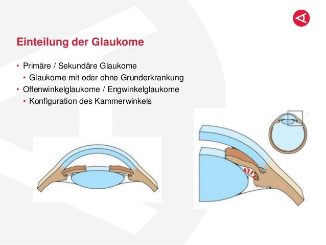 Glaukomdiagnostik: Was sagt mir was?