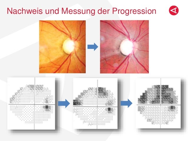 Glaukomdiagnostik: Was sagt mir was?
