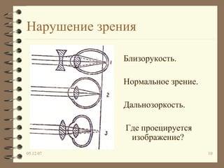Нарушение зрения Близорукость. Нормальное зрение. Дальнозоркость. Где проецируется изображение? 