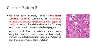 Gleason Pattern 3
• has been seen in many series as the most
common pattern, comprised of individual,
discrete and distinct neoplastic glands, typically
small, but often of variable sizes and infiltrating
into the stroma in between the benign glands.
• included cribriform structures, some with
irregular contours, and some within small,
smooth, rounded glandular spaces, or “gland in
gland formation”, i.e., glomerulation
 