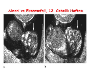 Akrani ve Ekzensefali, 12. Gebelik Haftası
 