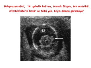 Holoprozensefali, 14. gebelik haftası, talamik füzyon, tek ventrikül,
interhemisferik fissür ve falks yok, beyin dokusu görülmüyor
 