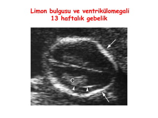 Limon bulgusu ve ventrikülomegali
13 haftalık gebelik
 