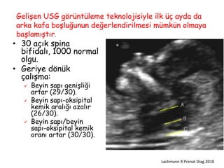 • 30 açık spina
bifidalı, 1000 normal
olgu.
• Geriye dönük
çalışma:
 Beyin sapı genişliği
artar (29/30).
 Beyin sapı-oksipital
kemik aralığı azalır
(26/30).
 Beyin sapı/beyin
sapı-oksipital kemik
oranı artar (30/30).
Lachmann R Prenat Diag 2010
®
Gelişen USG görüntüleme teknolojisiyle ilk üç ayda da
arka kafa boşluğunun değerlendirilmesi mümkün olmaya
başlamıştır.
 