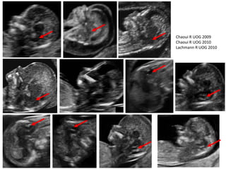 Chaoui R UOG 2009
Chaoui R UOG 2010
Lachmann R UOG 2010
 