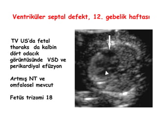 TV US’da fetal
thoraks da kalbin
dört odacık
görüntüsünde VSD ve
perikardiyal efüzyon
Artmış NT ve
omfalosel mevcut
Fetüs trizomi 18
Ventriküler septal defekt, 12. gebelik haftası
 
