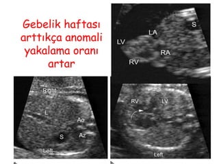 Gebelik haftası
arttıkça anomali
yakalama oranı
artar
 
