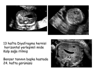13 hafta Diyafragma hernisi
horizontal yerleşimli mide
Kalp sağa itilmiş
Benzer tanının başka hastada
24. hafta görünüsü
 