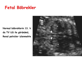 Fetal Böbrekler
Normal böbreklerin 13. h
da TV US ile görünümü,
Renal pelvisler izlenmekte
 