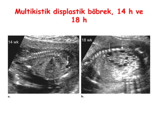 Multikistik displastik böbrek, 14 h ve
18 h
 
