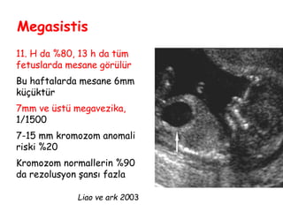 Megasistis
11. H da %80, 13 h da tüm
fetuslarda mesane görülür
Bu haftalarda mesane 6mm
küçüktür
7mm ve üstü megavezika,
1/1500
7-15 mm kromozom anomali
riski %20
Kromozom normallerin %90
da rezolusyon şansı fazla
Liao ve ark 2003
 