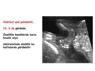 Clubfoot and polidaktili,
14. h da görünüm
Özellikle kemiklerde bariz
kısalık veya
ekstremitede eksiklik bu
haftalarda görülebilir
 