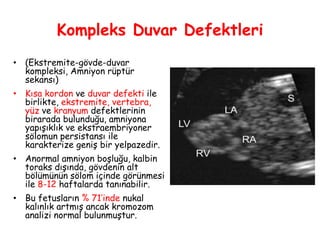 Kompleks Duvar Defektleri
• (Ekstremite-gövde-duvar
kompleksi, Amniyon rüptür
sekansı)
• Kısa kordon ve duvar defekti ile
birlikte, ekstremite, vertebra,
yüz ve kranyum defektlerinin
birarada bulunduğu, amniyona
yapışıklık ve ekstraembriyoner
sölomun persistansı ile
karakterize geniş bir yelpazedir.
• Anormal amniyon boşluğu, kalbin
toraks dışında, gövdenin alt
bölümünün sölom içinde görünmesi
ile 8-12 haftalarda tanınabilir.
• Bu fetusların % 71’inde nukal
kalınlık artmış ancak kromozom
analizi normal bulunmuştur.
 