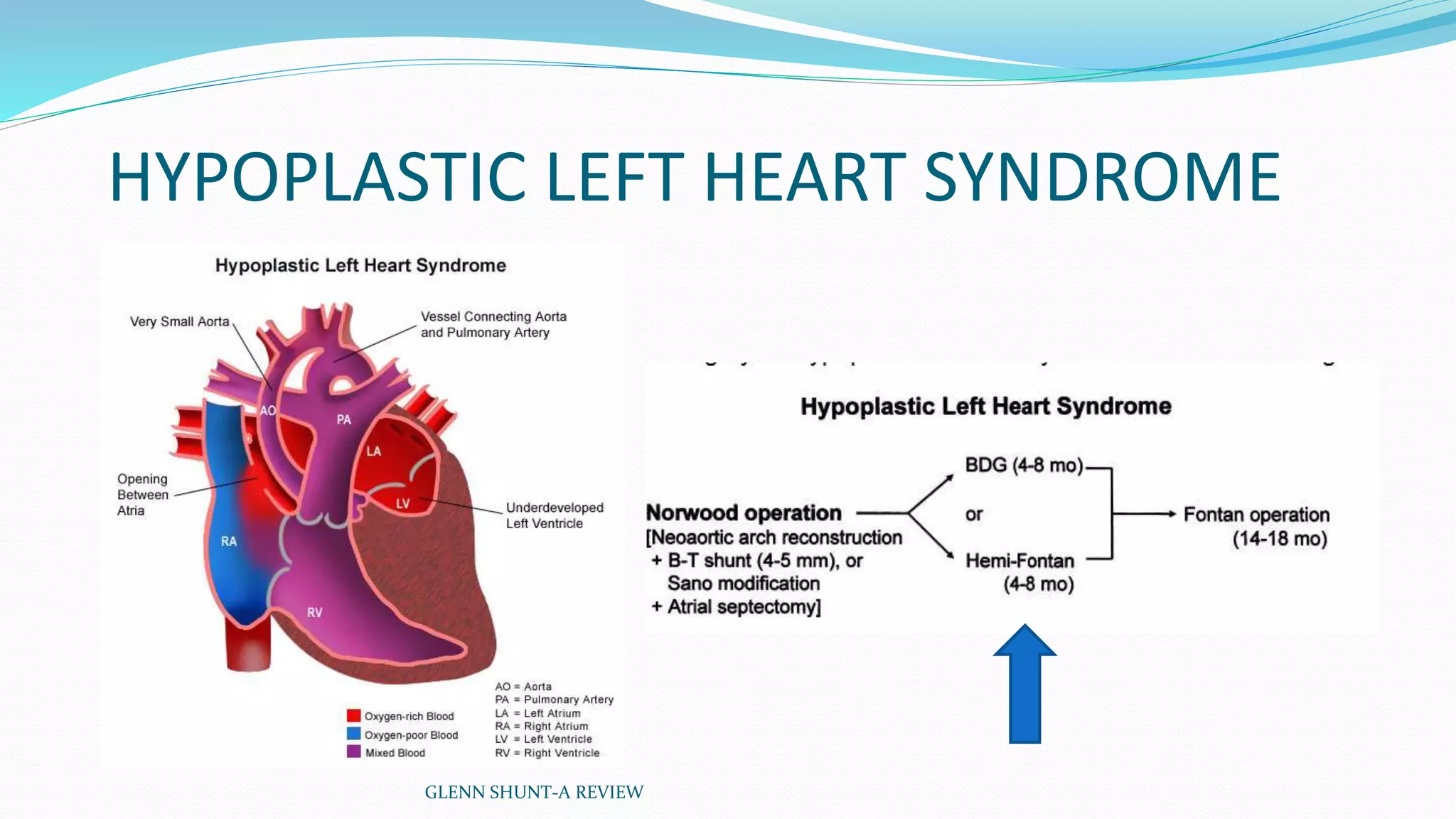 HYPOPLASTIC LEFT HEART SYNDROME 
GLENN SHUNT-A REVIEW 
 