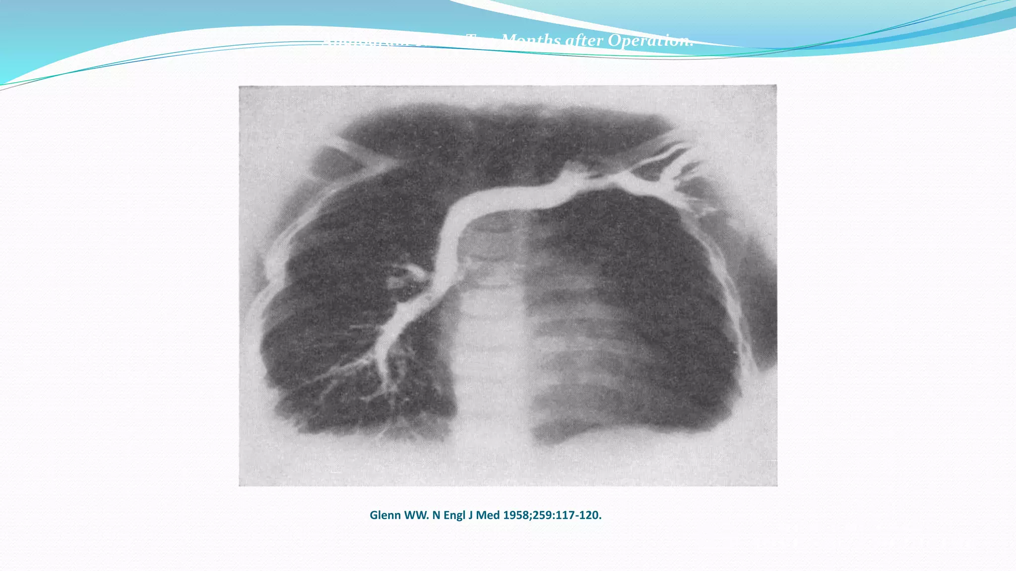 Angiogram Taken Two Months after Operation. 
Glenn WW. N Engl J Med 1958;259:117-120. 
 
