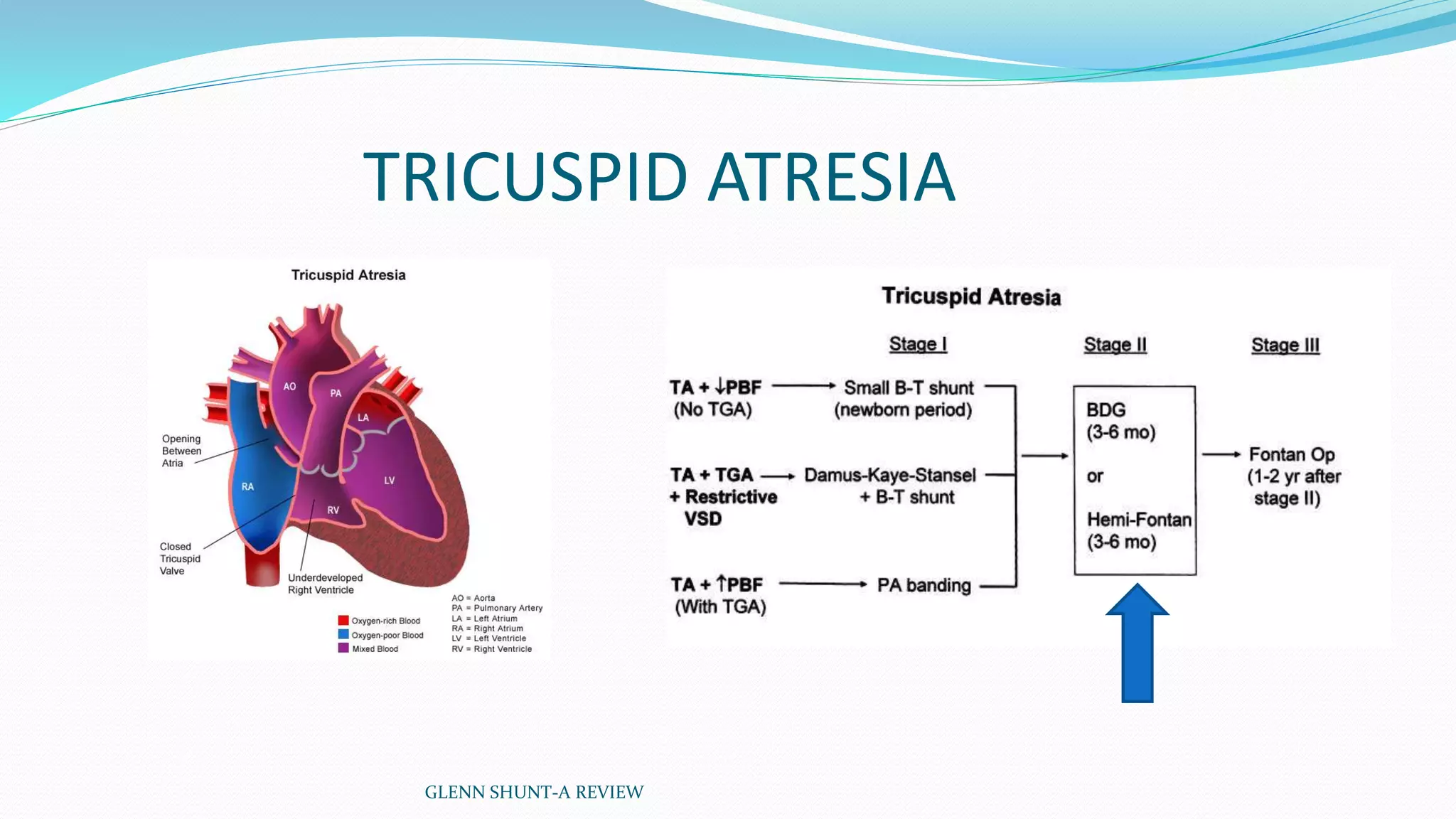 TRICUSPID ATRESIA 
GLENN SHUNT-A REVIEW 
 