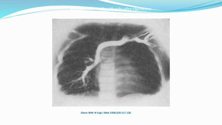 Angiogram Taken Two Months after Operation. 
Glenn WW. N Engl J Med 1958;259:117-120. 
 