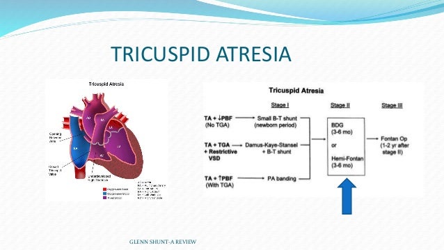 tricuspid atresia