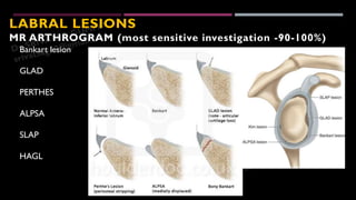 Glenohumeral instability Radiological evaluation - Dr Srivatsa Gumma | PDF