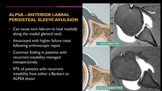 Glenohumeral instability Radiological evaluation - Dr Srivatsa Gumma | PDF