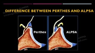 Glenohumeral instability Radiological evaluation - Dr Srivatsa Gumma | PDF