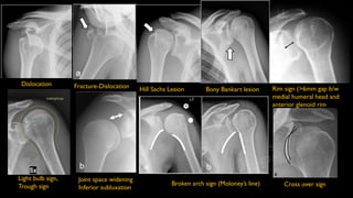 Glenohumeral instability Radiological evaluation - Dr Srivatsa Gumma | PDF