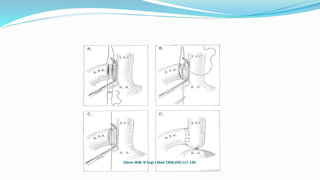 Shunt between the Superior Vena Cava and Right Pulmonary Artery — Technic of Anastomosis.
Glenn WW. N Engl J Med 1958;259:117-120.
 