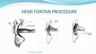 HEMI FONTAN PROCEDURE
GLENN SHUNT-A REVIEW
 