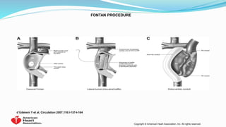 FONTAN PROCEDURE
d’Udekem Y et al. Circulation 2007;116:I-157-I-164
Copyright © American Heart Association, Inc. All rights reserved.
 