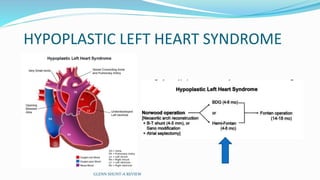 HYPOPLASTIC LEFT HEART SYNDROME
GLENN SHUNT-A REVIEW
 